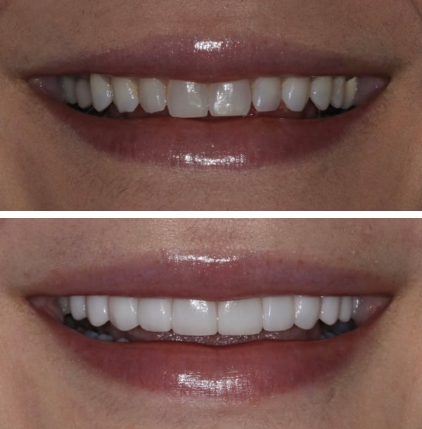 before and after image of teeth 1