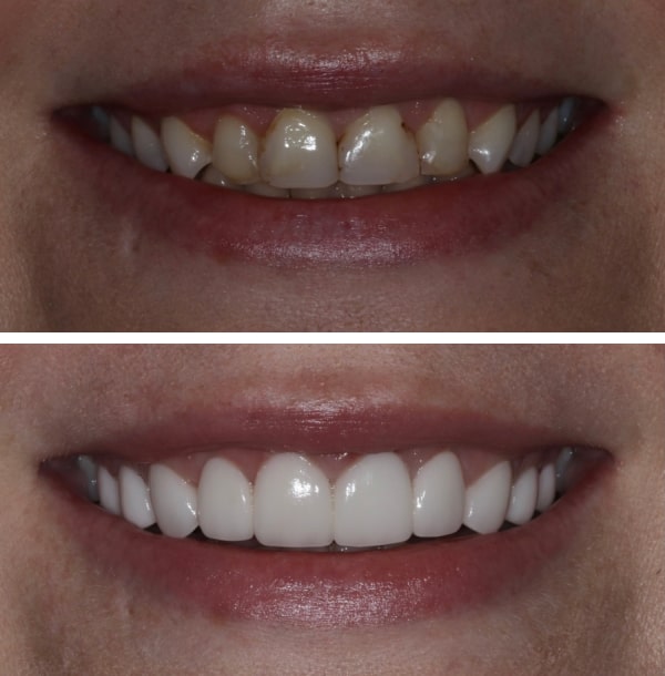 before and after image of teeth 2