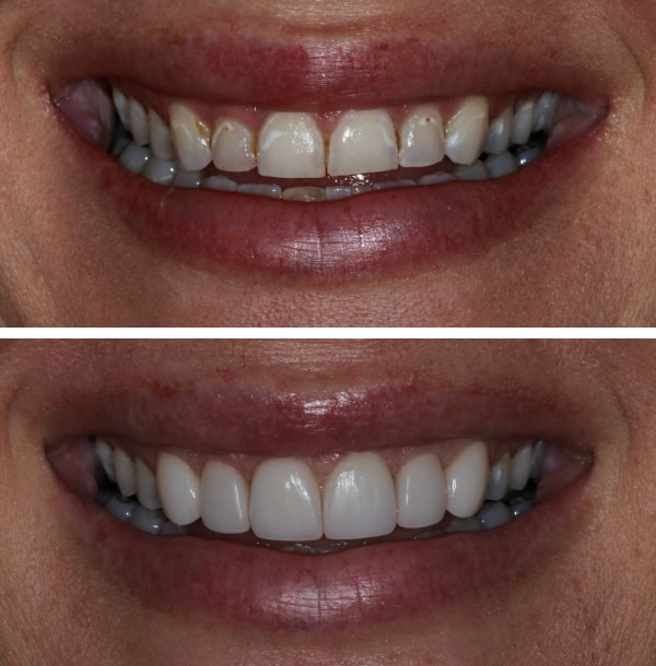 before and after image of teeth 3