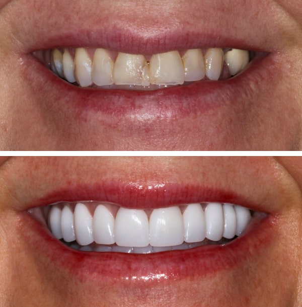 before and after image of teeth 4